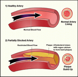 Blocked Blood Vessels